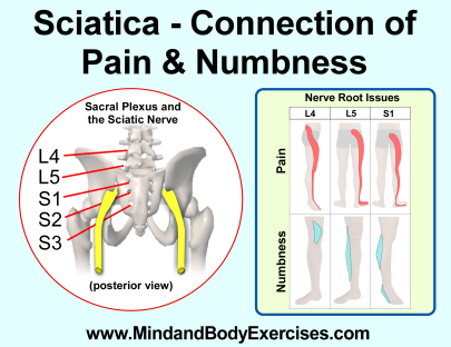 sciatica-pain &amp; numbness